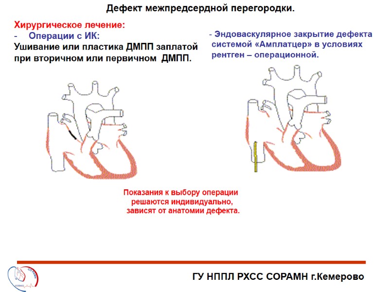 ГУ НППЛ РХСС СОРАМН г.Кемерово Дефект межпредсердной перегородки.  Эндоваскулярное закрытие дефекта  